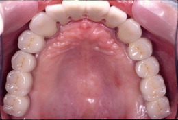 無歯顎インプラント症例（フルマウス症例） After