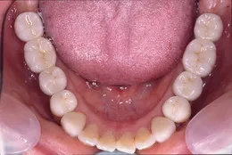 臼歯部のインプラント症例 CaseⅡ After